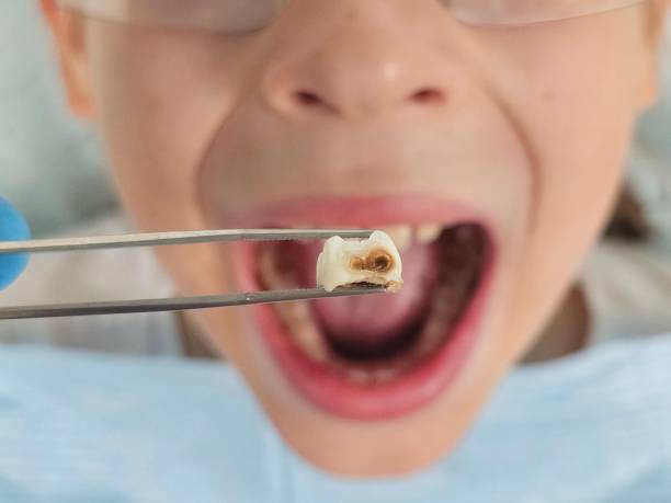 Best Emergency Wisdom Teeth Removal in Henryetta, OK